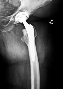 Wright Hip Lawsuit