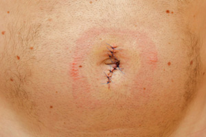 Male with severe hernia condition